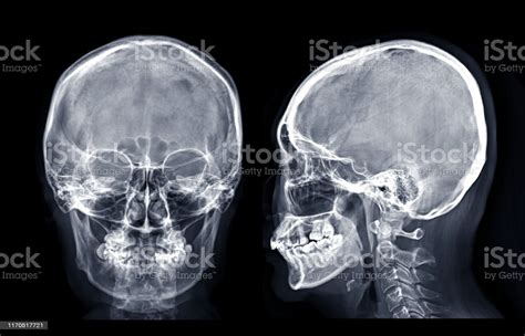 Paranasal sinuses + mastoid air cells (X-Ray) Diagram | Quizlet