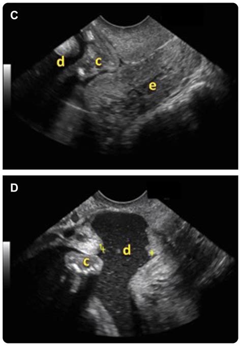 Ultrasound images A, Dichorionic-diamniotic twin pregnancy with ...