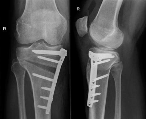 Wysoka osteotomia kości piszczelowej (HTO). Co warto o niej wiedzieć ...