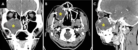 [PDF] Mucocele in the maxillary sinus involving the orbit: A report of 2 cases | Semantic Scholar