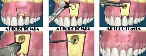 Alexander Graham Bell grammatica Risorse ricostruire un dente devitalizzato parametri Assunzione ...