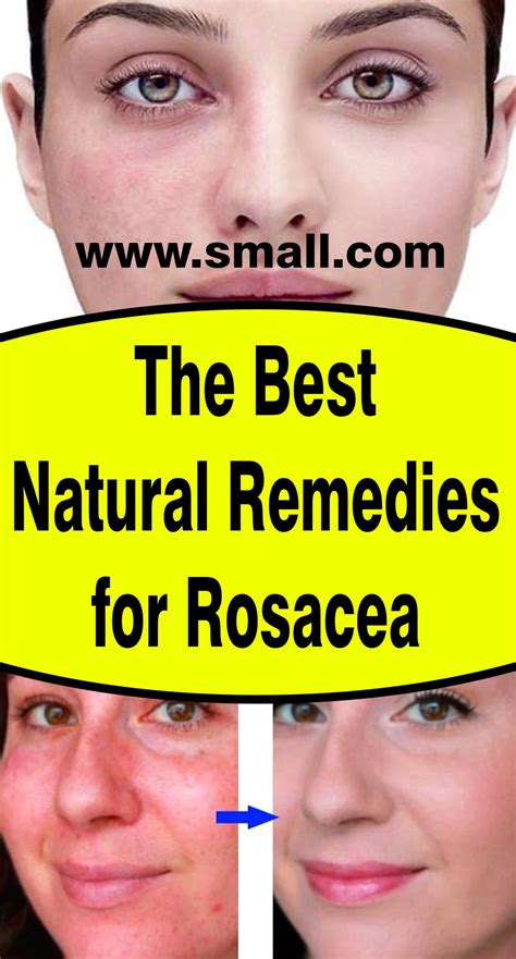 The Best Natural Remedies for Rosacea | Natural remedies for rosacea ...