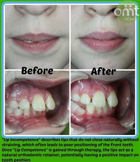 tongue thrust treatment for adults - jacobos-mezquita