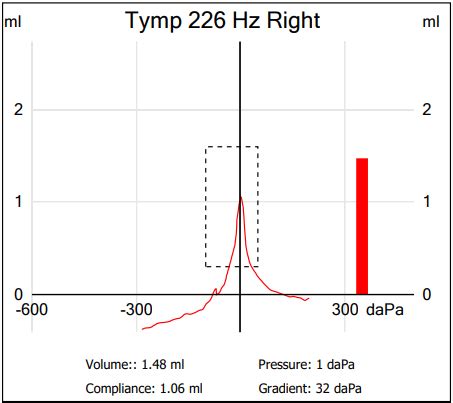 Tympanometry: What It Is and Types of Tympanogram Readings