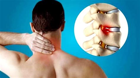 Cervical Spondylosis: What are its Symptoms & Treatment? - Arun Bhanot