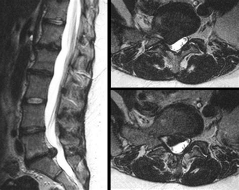 Herniated Disc Mri L5 S1 - Lumbar Herniated Disc - A More in Depth Look ...