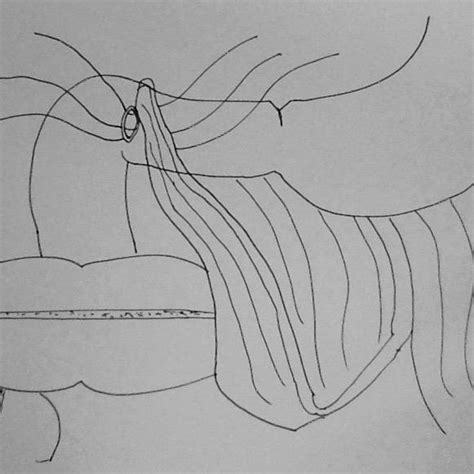 Omental Patch Repair | Download Scientific Diagram