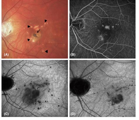 Central multifocal choroiditis in the left eye. (A) Colour fundus... | Download Scientific Diagram