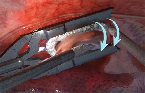 Subxiphoid Minimally Invasive Epicardial Ablation (Convergent Procedure ...