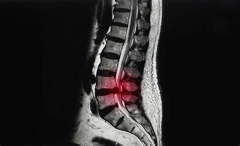 Lumbar Spinal Stenosis