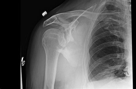 Scapula Fractures - Trauma - Orthobullets