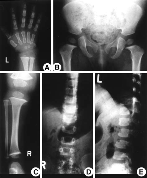 Hypochondroplasia. Causes, symptoms, treatment Hypochondroplasia