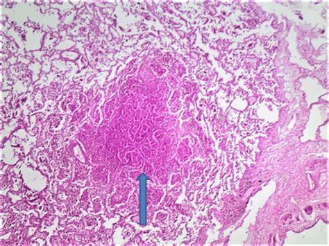 Caseating granuloma in lung (Micrograph at x 4 magnification). | Download Scientific Diagram