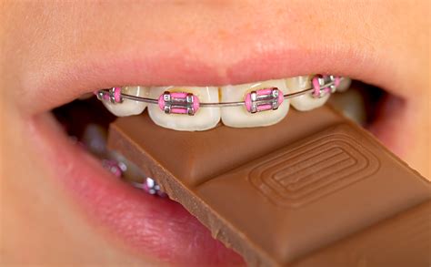 Halloween Tips for Braces: Don't Be Haunted by Sticky Treats