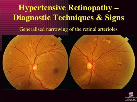 Hypertensive Retinopathy