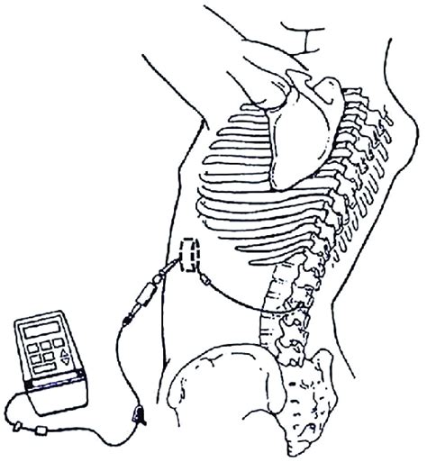 Schematic diagram of a pulsed infusion pump connected to an epidural ...