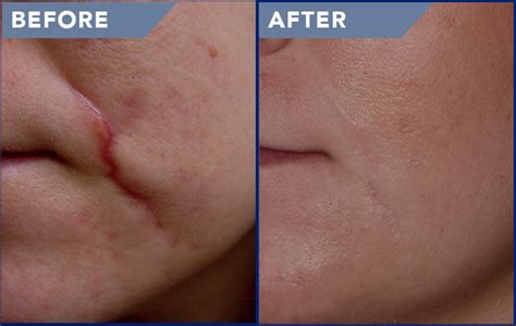 Laser Scar Removal Photos - Soderstrom Skin Institute