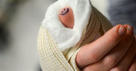 Broken Thumb: Symptoms, Treatment, Recovery, Complications, and More