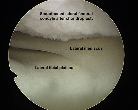 Extensive Arthroscopic Chondroplasty for Cartilage Hyperplasia of the Femoral Condyle Causing ...