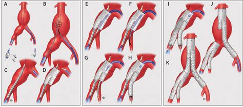 Endovascular Today - Techniques of Endovascular Aortoiliac Repair Using ...