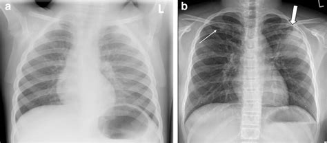 Chest radiography in children with cystic fibrosis and acute pulmonary ...