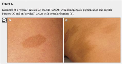 Café au Lait Spots, Macules, In Babies, Adults, On Face, Causes, Differential Diagnosis, Removal ...