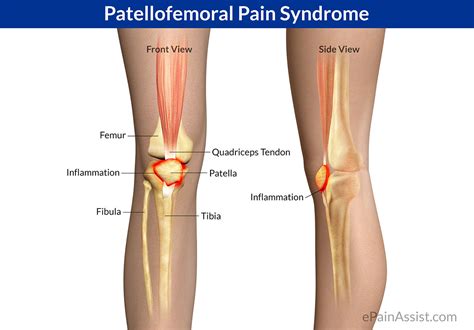 Patellofemoral-Pain-Syndrome - Podiatry HQ