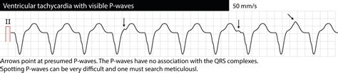 Ventricular tachycardia (VT): ECG criteria, causes, classification, treatment (management) – ECG ...