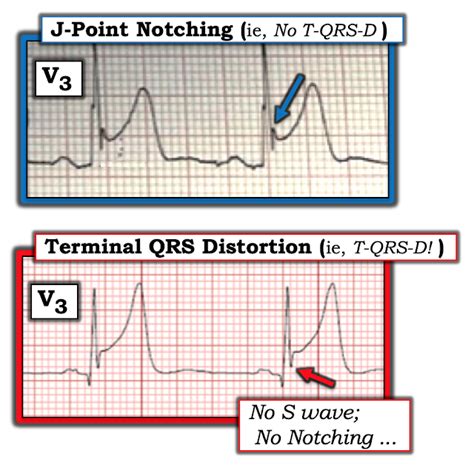 Dr. Smith's ECG Blog: A 50-something with left shoulder pain and diffuse ST elevation