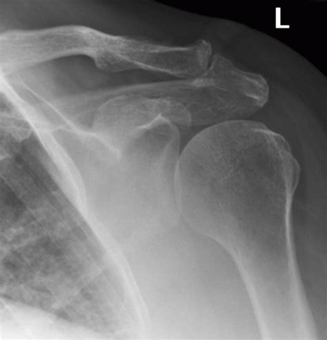 Degeneration Of Acromioclavicular Joint