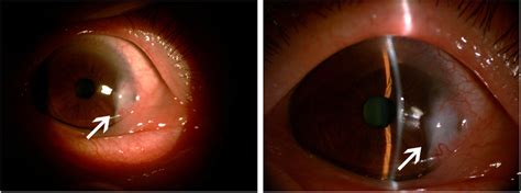 Seven months after the treatment with tocilizumab. Visio oculus dexter,... | Download Scientific ...