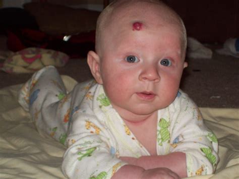 Red Birthmarks - BabyCenter