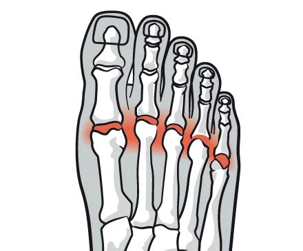 Metatarsalgia Symptoms, Causes, and Treatment - SportsMD