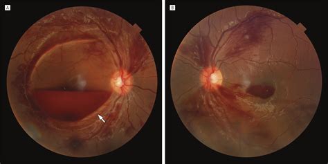 Subinternal Limiting Membrane Hemorrhage With Perimacular Fold in ...