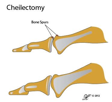 Cheilectomy - Orthoanswer