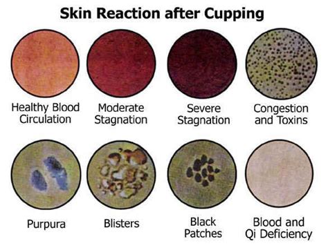 Skin Reactions after Cupping | Cupping therapy, Cupping massage ...