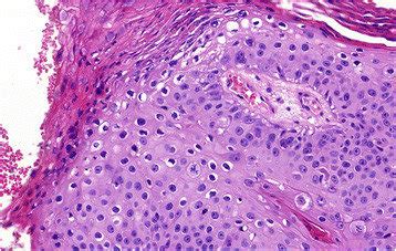 Koilocyte-like change in the superficial part of dysplastic epithelium ...