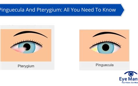 Pinguecula And Pterygium: All You Need To Know | Eyemantra Hospital