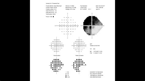 RS Visual Fields Part 2 Interpreting The Test Results - YouTube