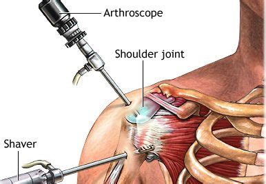 Shoulder Arthritis: What You Need To Know | OSV