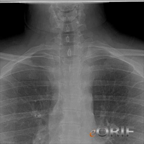 Sternoclavicular Joint Dislocation S43.206A 839.61 | eORIF