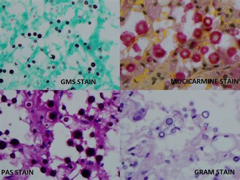 Cryptococcus - StatPearls - NCBI Bookshelf