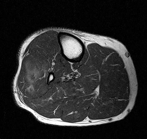 Foot Muscles Mri - MRI with user outlined plantar intrinsic and extrinsic ... / Muscles that ...