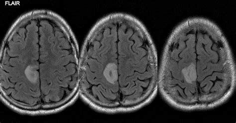 Neuroradiology Cases: Parietal lobe lesion on MRI