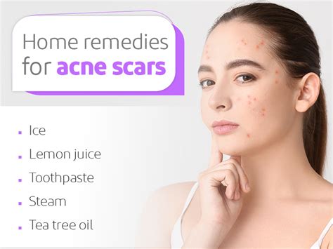 Home Remedies for Acne Scars