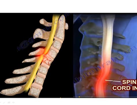 Pathophysiology and Treatment of Spinal Cord Injury — OrthopaedicPrinciples.com