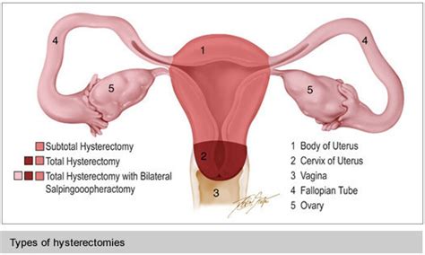 Hysterectomy – Fibroid Treatment Collaborative