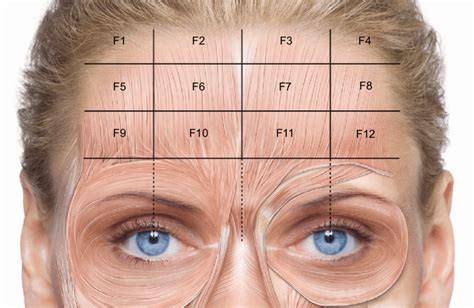 Injection points for the treatment of horizontal forehead lines. | Download Scientific Diagram