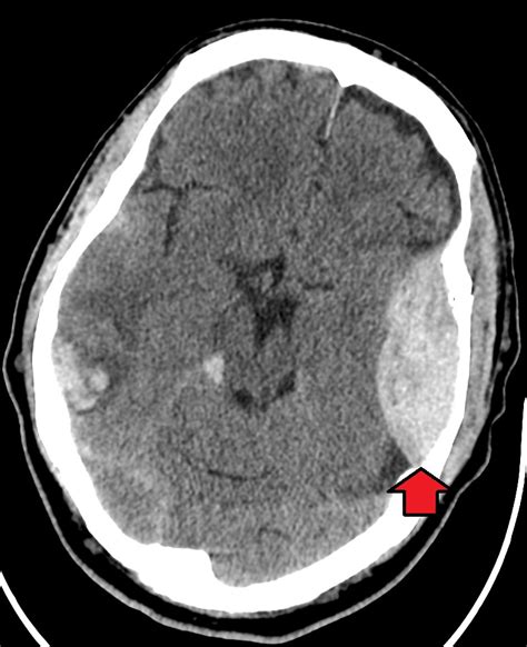 Hemorragia Epidural Tac