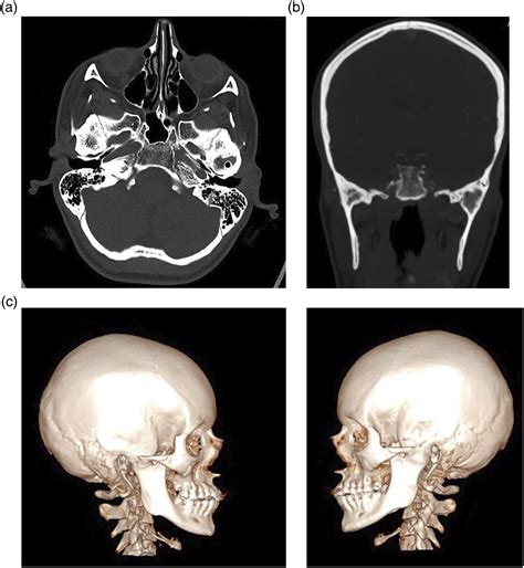 Bilateral TMJ Ankylosis: Total Joint Reconstruction in a Patient With ...